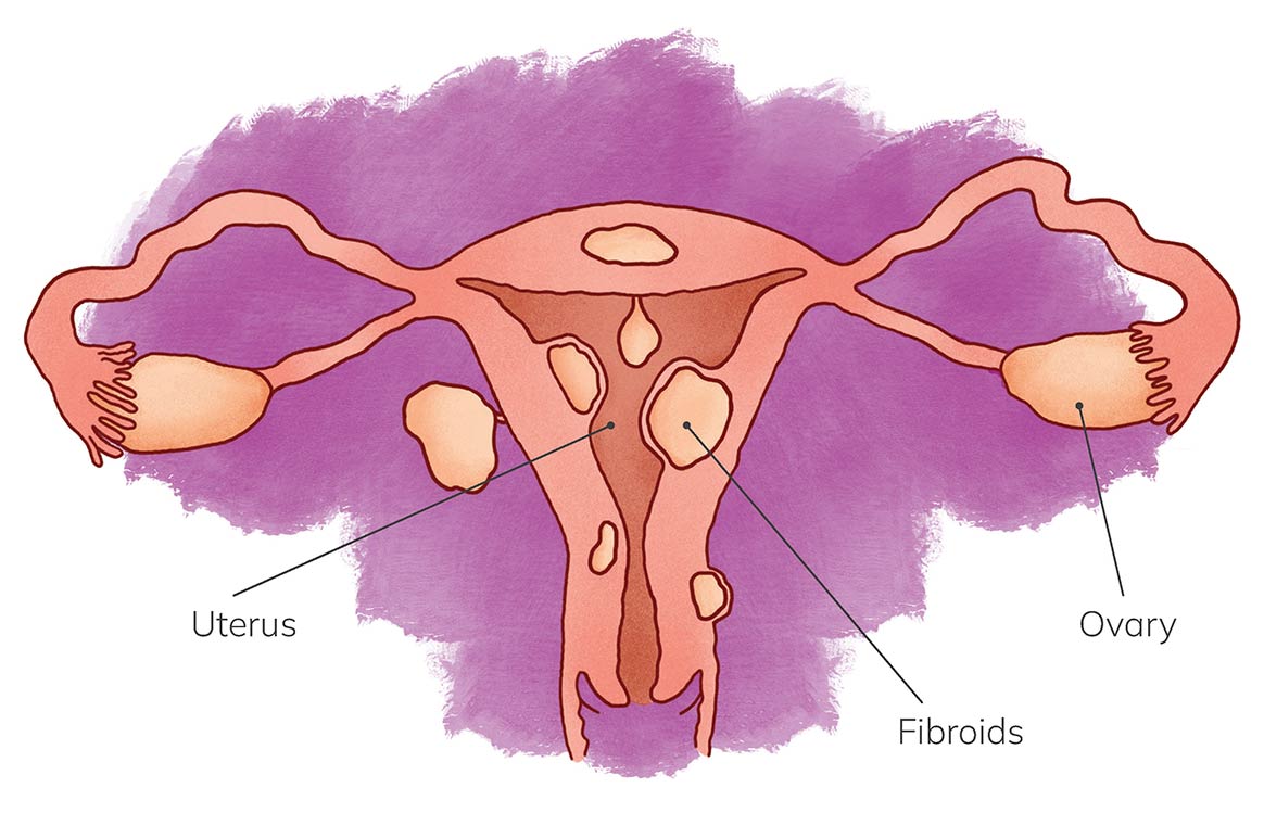 Anatomical illustration of uterus with fibroids