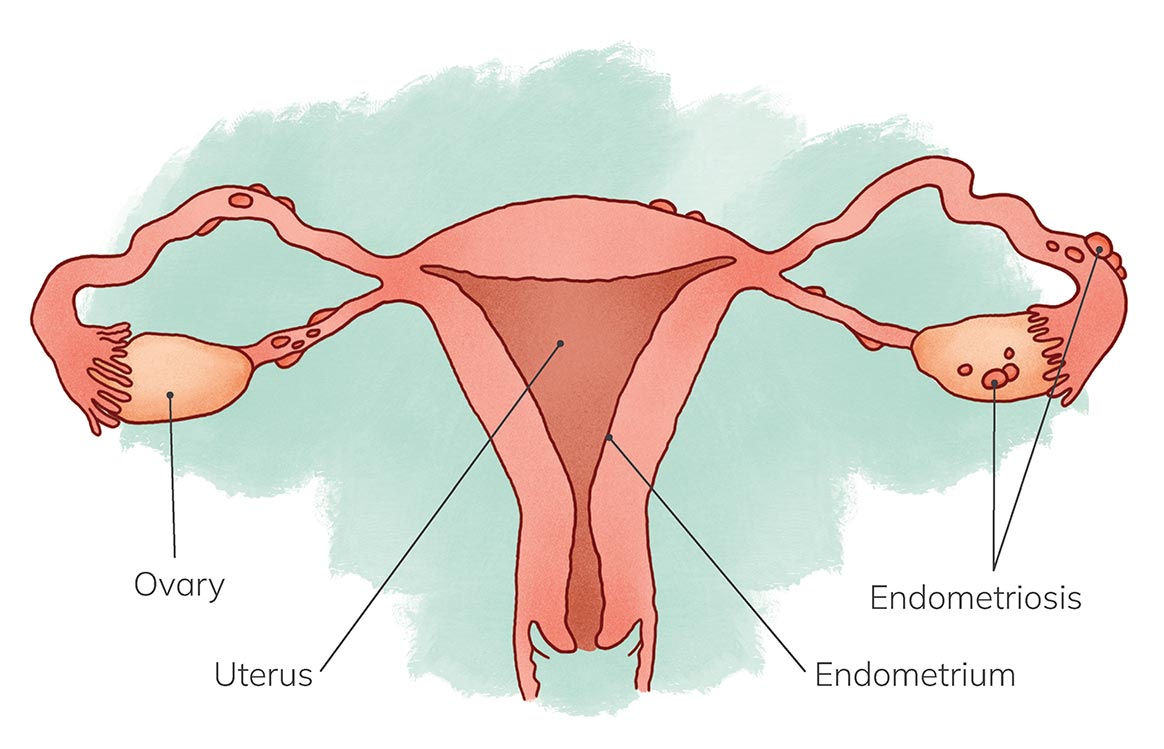 Anatomical illustration of uterus with endometriosis lesions